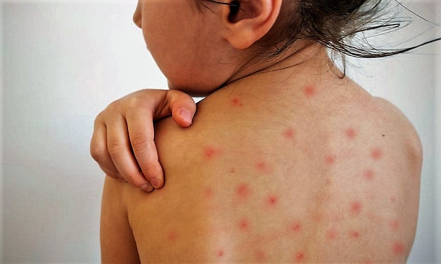 SALUD: Ante inminente brote de sarampión, insisten en vacunar a los niños