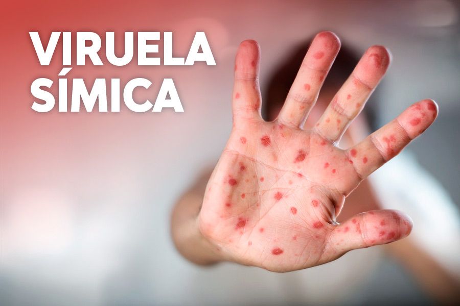 NACIONALES: Hay 119 casos de viruela símica en el país: el 99% de infectados son hombres